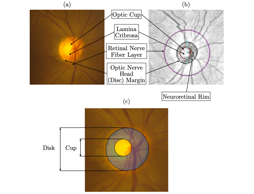 11-14-2019-glaucoma